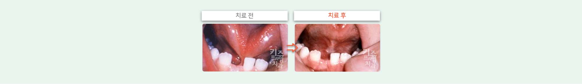 키즈프라임 