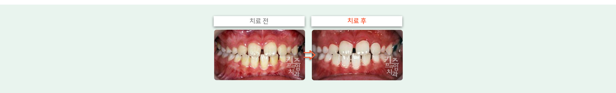 키즈프라임 