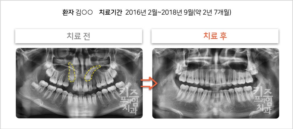 매복견치 견인 케이스01