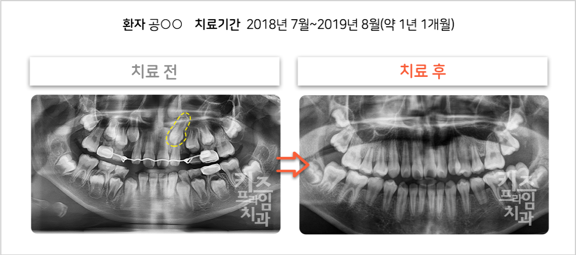 매복견치 견인 케이스02