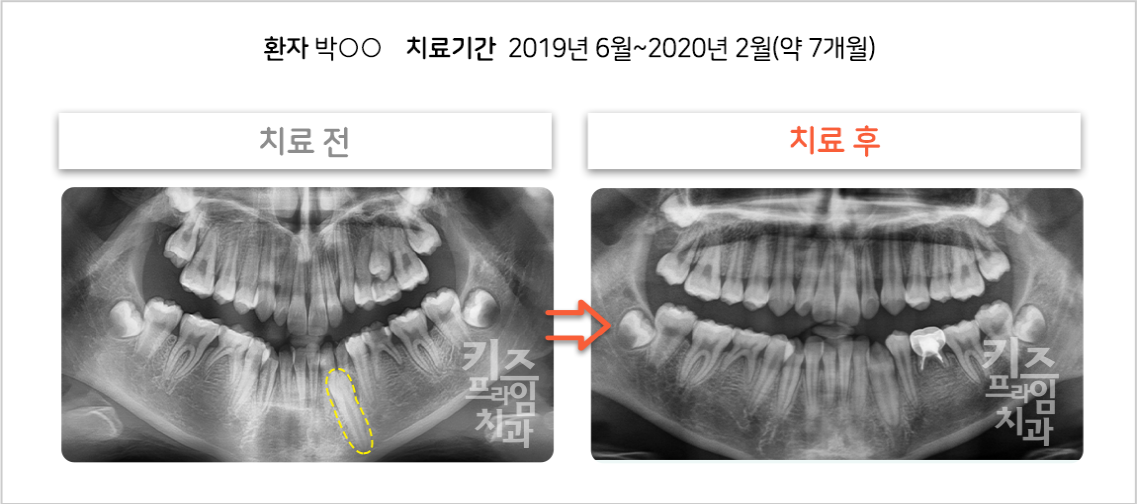 매복견치 견인 케이스03