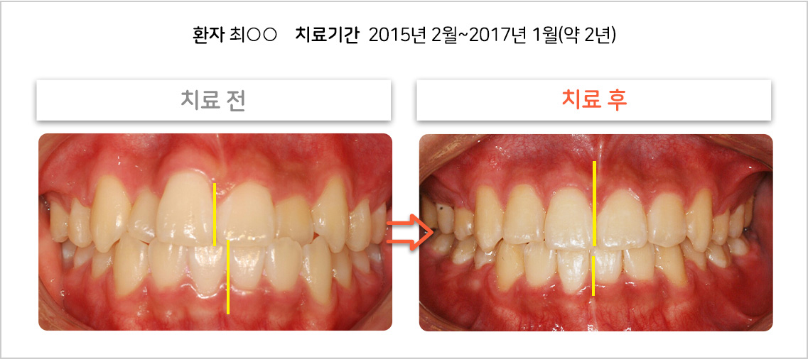 비대칭 교정 케이스01