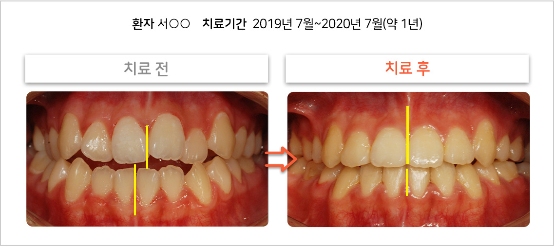 비대칭 교정 케이스02