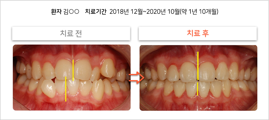 비대칭 교정 케이스03