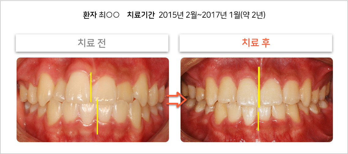 비대칭 교정 케이스04