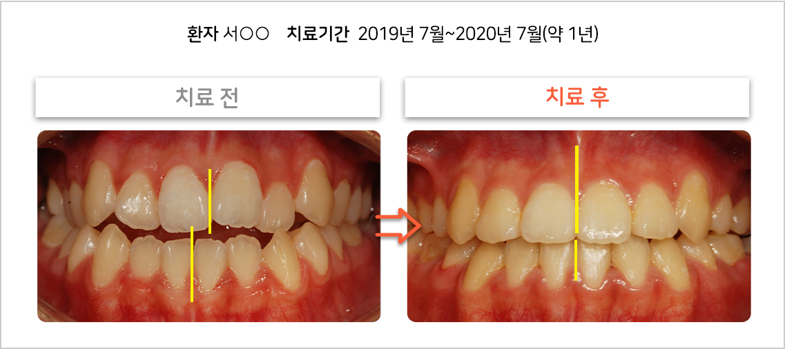 비대칭 교정 케이스05