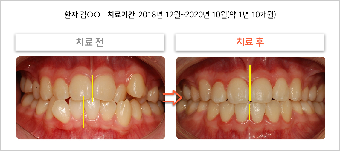 비대칭 교정 케이스06