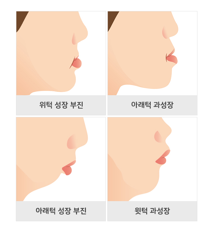 턱교정  