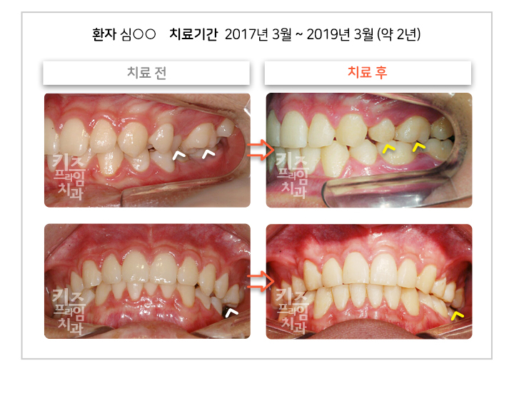 턱교정 