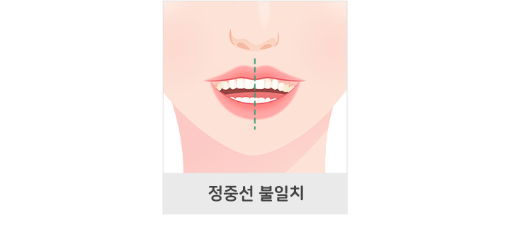 정중선 불일치