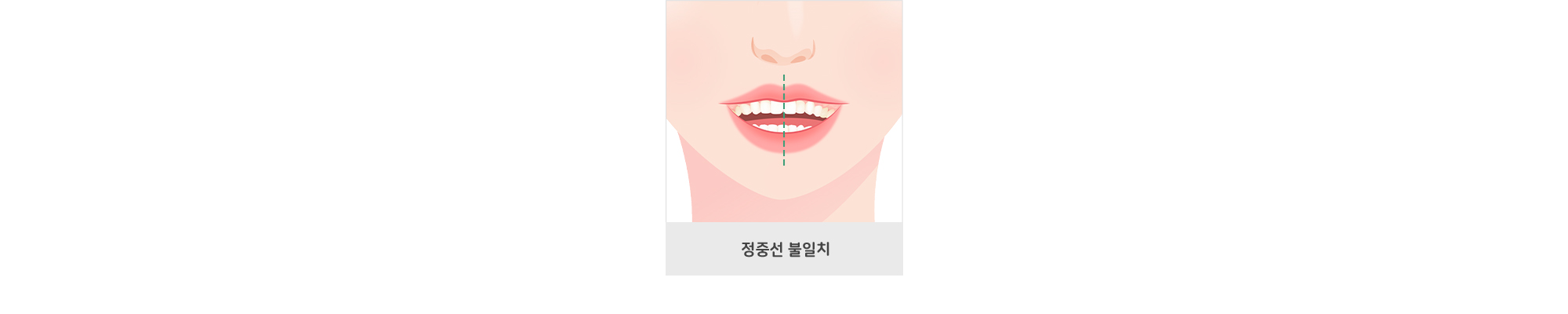 정중선 불일치