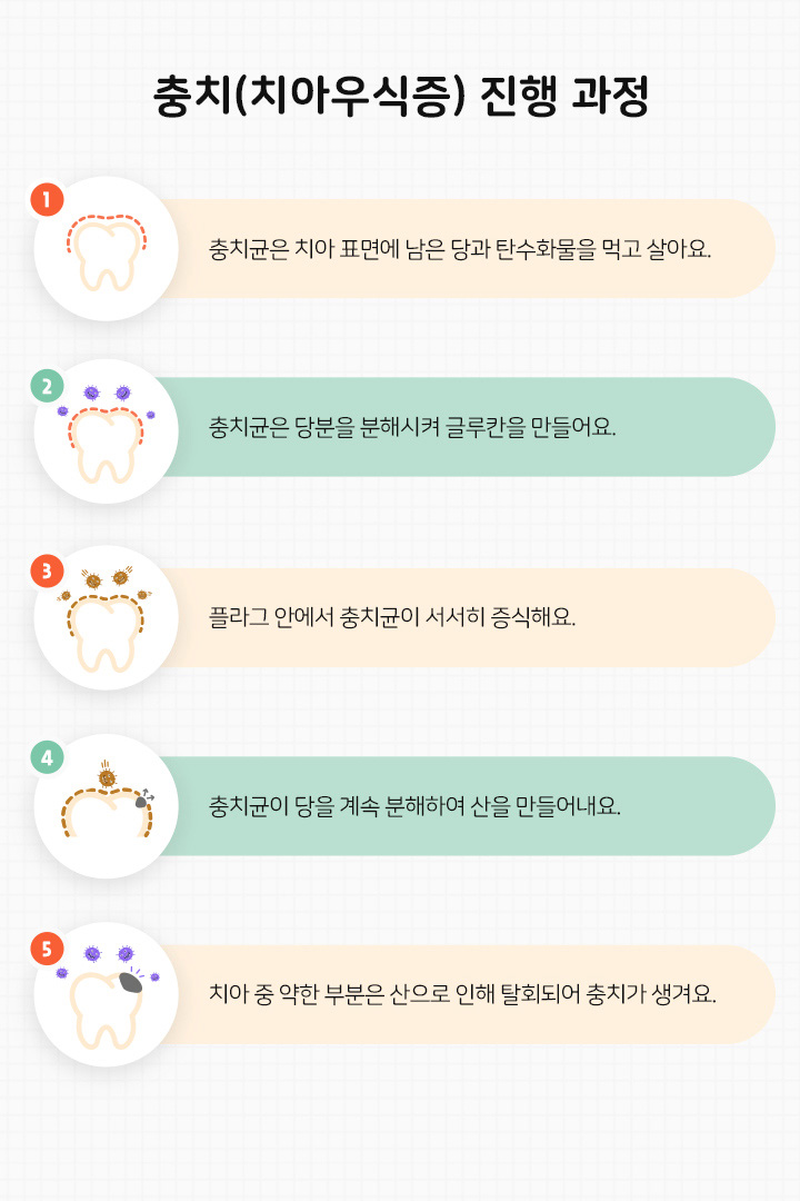 충치(치아우식증) 진행 과정 
