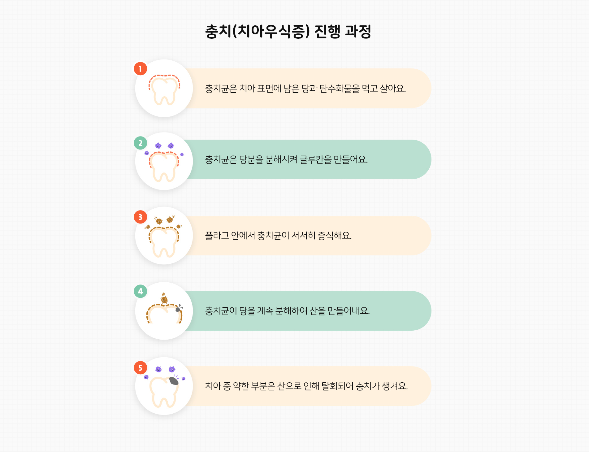 충치(치아우식증) 진행 과정 